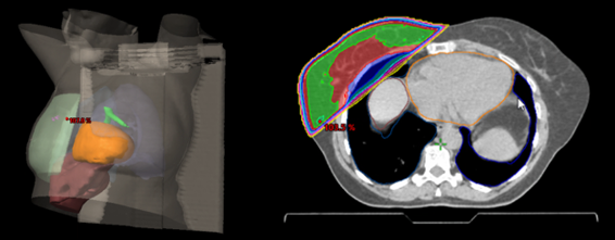 Two images are displayed on a screen. The left image shows a 3-D machine-generated scan of a tumour. The right image shows a stylised cross section that is roughly oval, with red and green areas placed to overlap on one edge